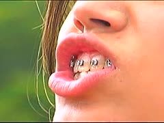 Junges Girl mit Zahnspange